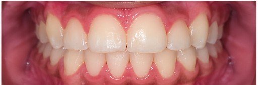 After photograph for Tooth alignment at The Dental Hut in Airoli. Not a named patient.