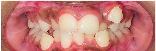 Before photograph for Tooth alignment at The Dental Hut in Airoli. Not a named patient.
