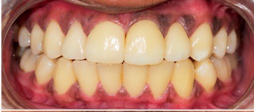 After photograph for Front spacing at The Dental Hut in Airoli. Not a named patient.