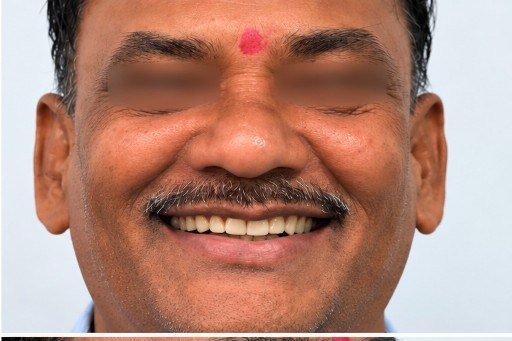 After photograph for Front tooth at The Dental Hut in Airoli. Not a named patient.