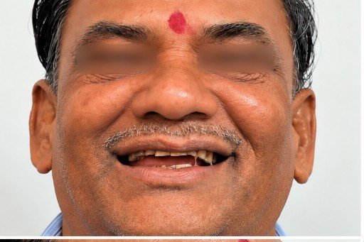 Before photograph for Front tooth at The Dental Hut in Airoli. Not a named patient.