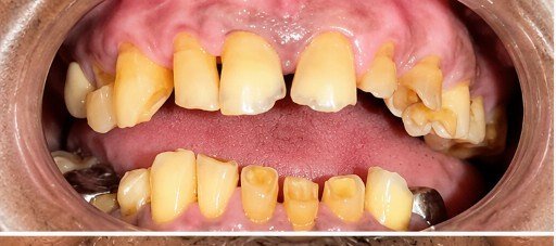 Before photograph for Full mouth photographs at The Dental Hut in Airoli. Not a named patient.