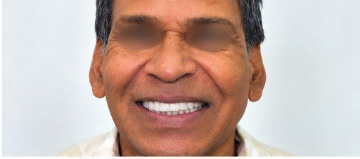 After photograph for Missing teeth at The Dental Hut in Airoli. Not a named patient.