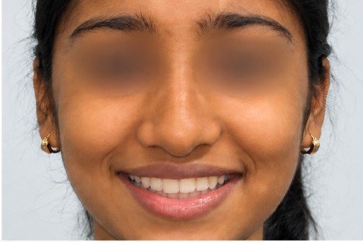 After photograph for Smile photographs at The Dental Hut in Airoli. Not a named patient.