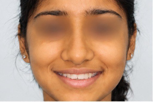 Before photograph for Smile photographs at The Dental Hut in Airoli. Not a named patient.