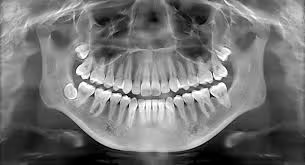 Educational example of a panoramic OPG X-ray. Not a named patient of The Dental Hut.