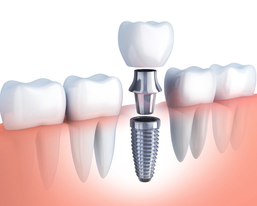 Educational illustration of a dental implant. Not a named patient of The Dental Hut.